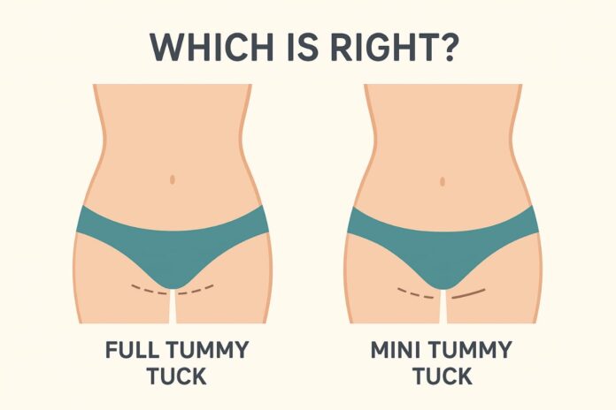Tummy tuck