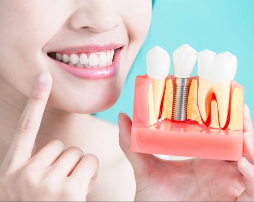 Dental Implants