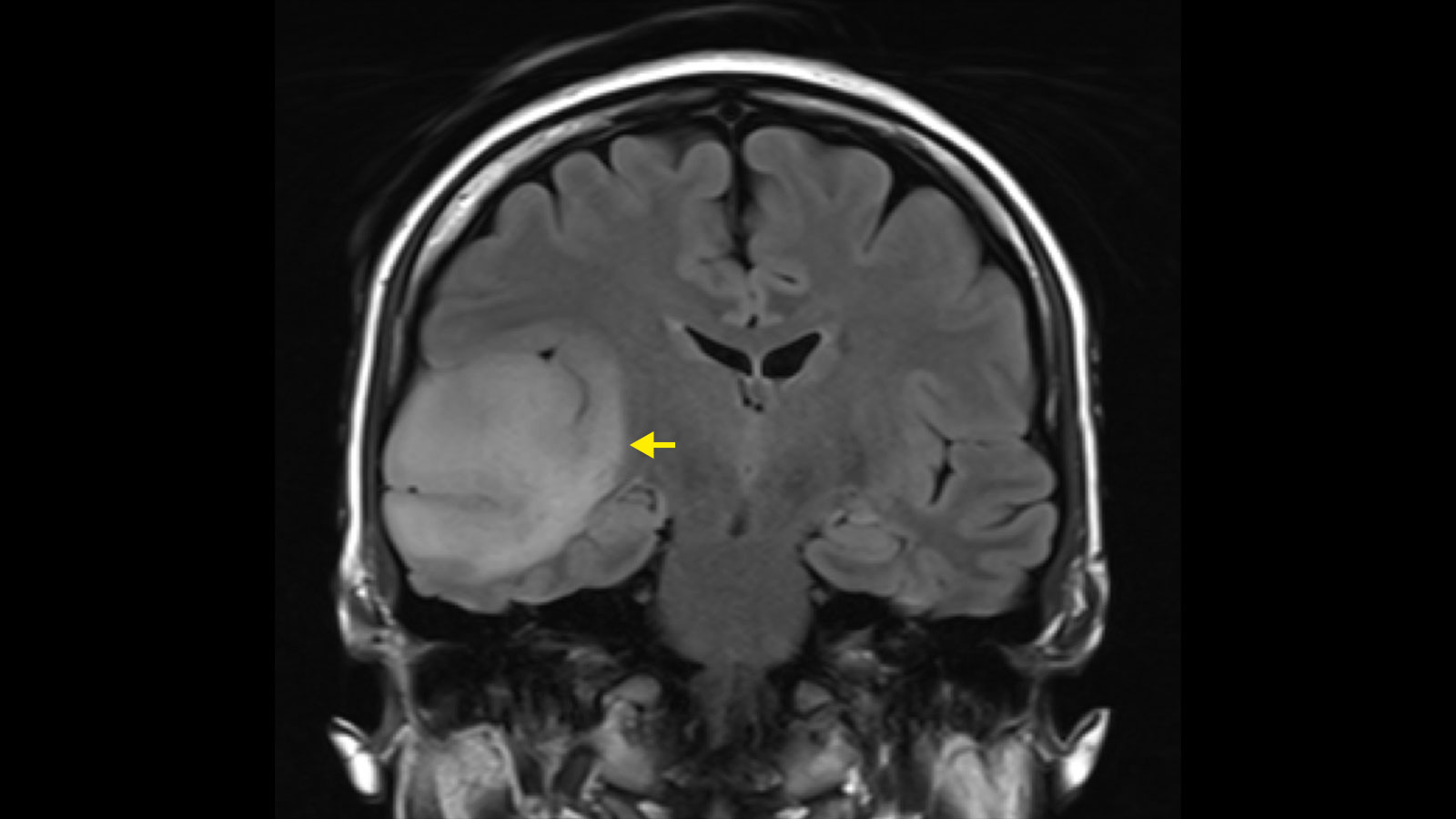 Understanding Glioma Tumor: Symptoms, Causes, Diagnosis, Treatment and Recovery Glioma Tumor